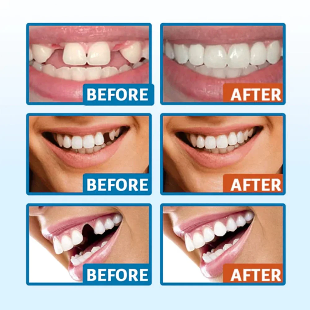 Glossy™ Glory Smile Temporary Tooth Sculptor Repair Kit